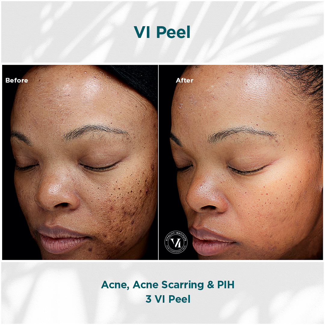 Acne, Scarring _ PIH_01