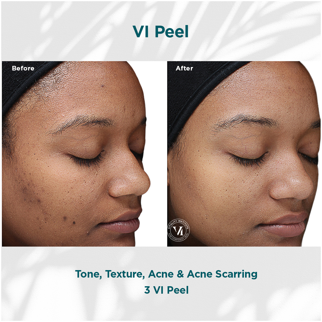 Tone, Texture, Acne _ Acne Scarring