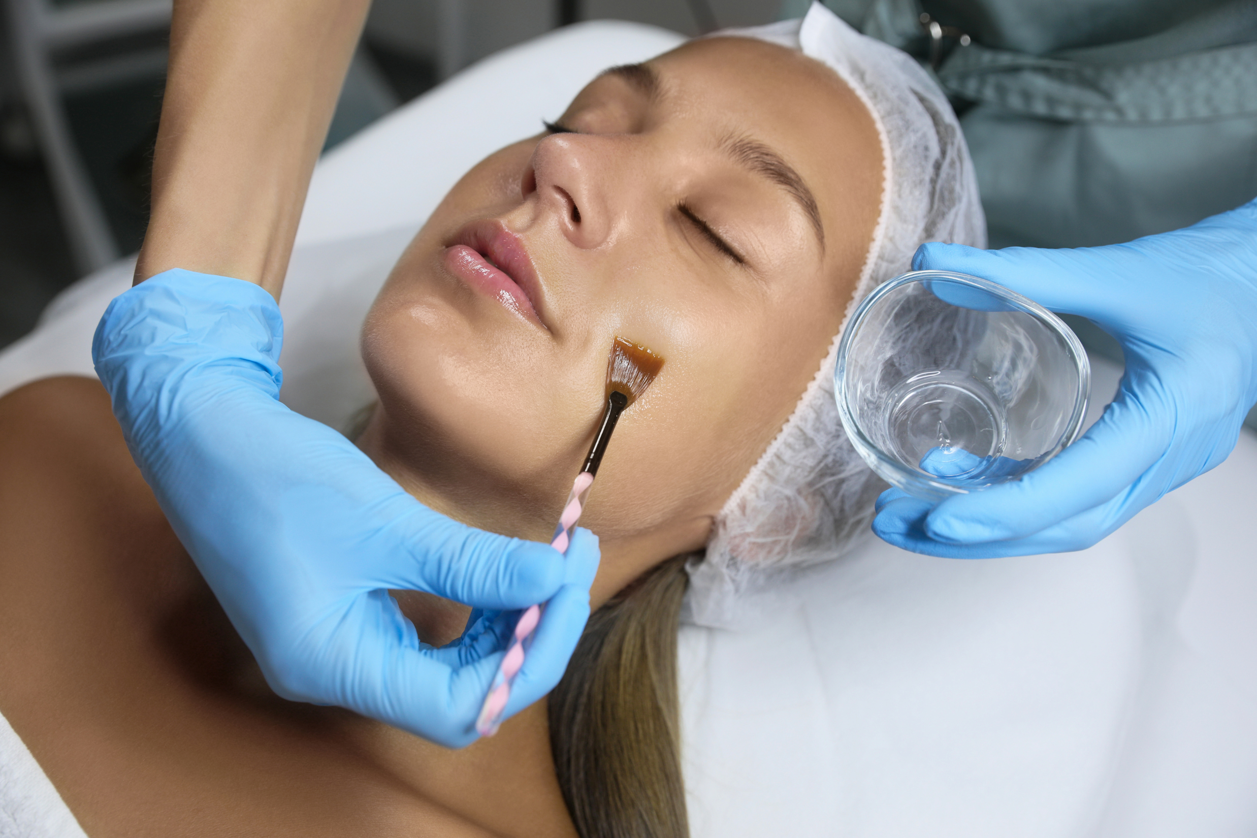 chemical-peel-vipeel